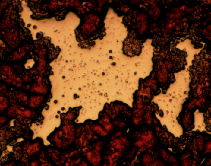 Abnormal dried sample