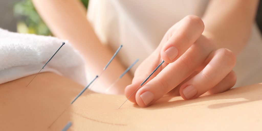 Acupuncture